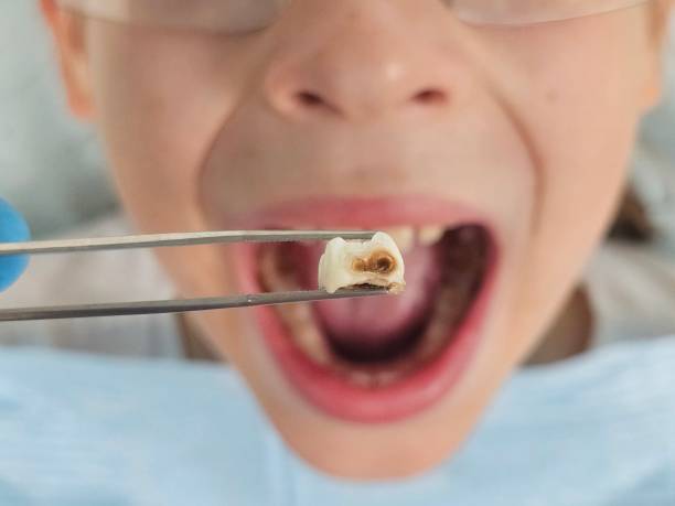 Best Urgent Care for Lost Fillings or Crowns in Canadian Lakes, MI