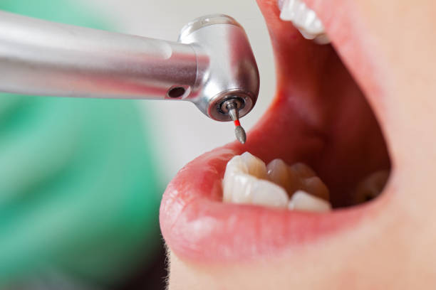 Best Emergency Wisdom Teeth Removal in Canadian Lakes, MI